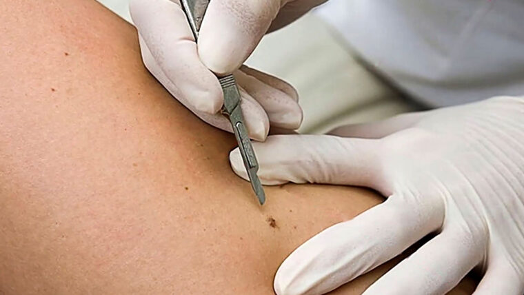 Cirurgia dermatológica